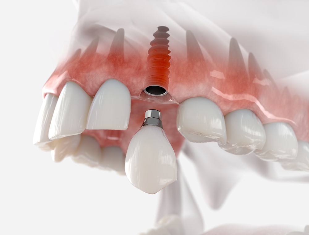 dental-implant